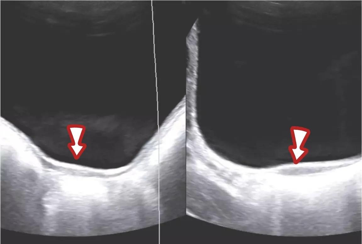 石女是什么情况,石女的症状是什么