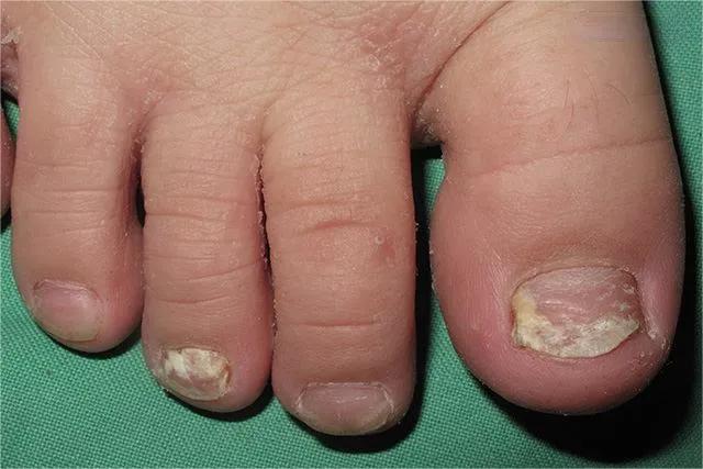 甲癣不严重怎么治疗,甲易生治疗灰指甲吗