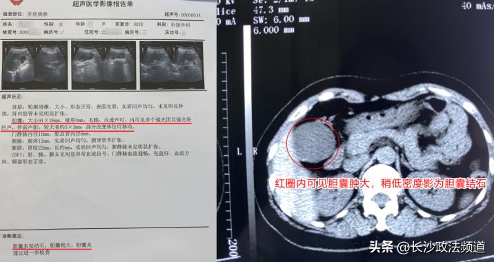 女子误把胆结石当胃病十余年,一女子胆里27颗胆结石