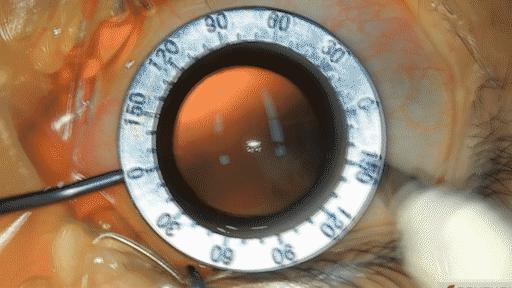 icl植入术技术问题,icd植入适应症指南