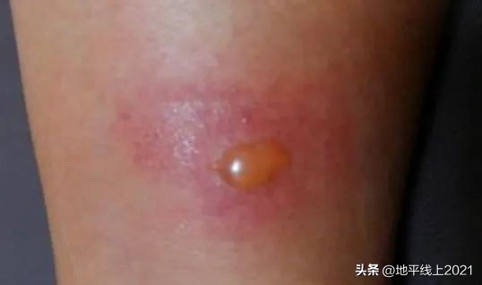 被蚊虫叮咬起大包涂仙人掌有用吗,儿童大腿内侧蚊虫叮咬大包红肿硬