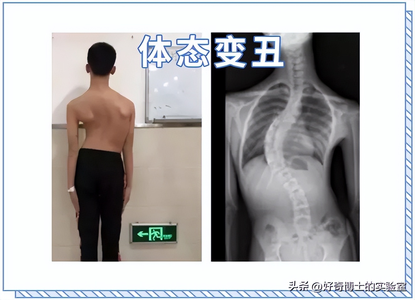 哪些姿势对腰部有损伤,哪种姿势对腰的伤害大