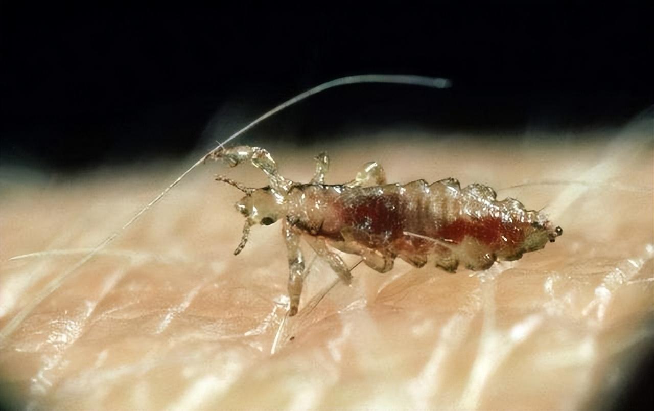 母女俩下腹瘙痒，医生用镊子夹出阴虱！原来阴虱有这4个传播途径