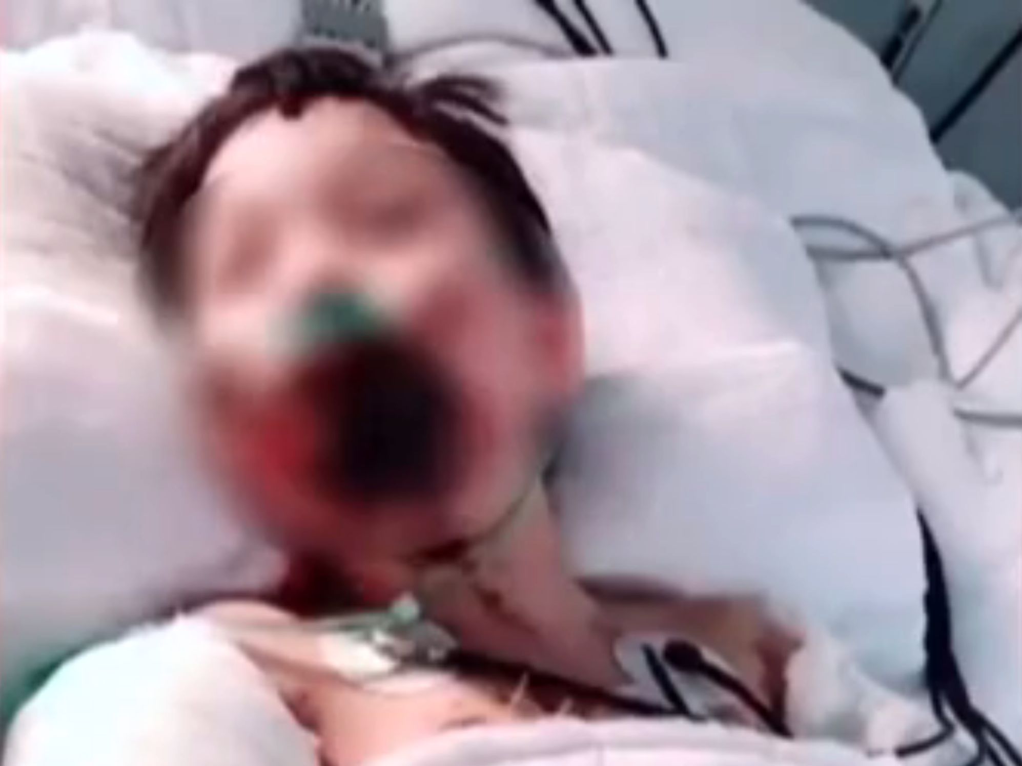 4岁留守女童全身重度烧伤,6岁女孩全身98%被重度烧伤