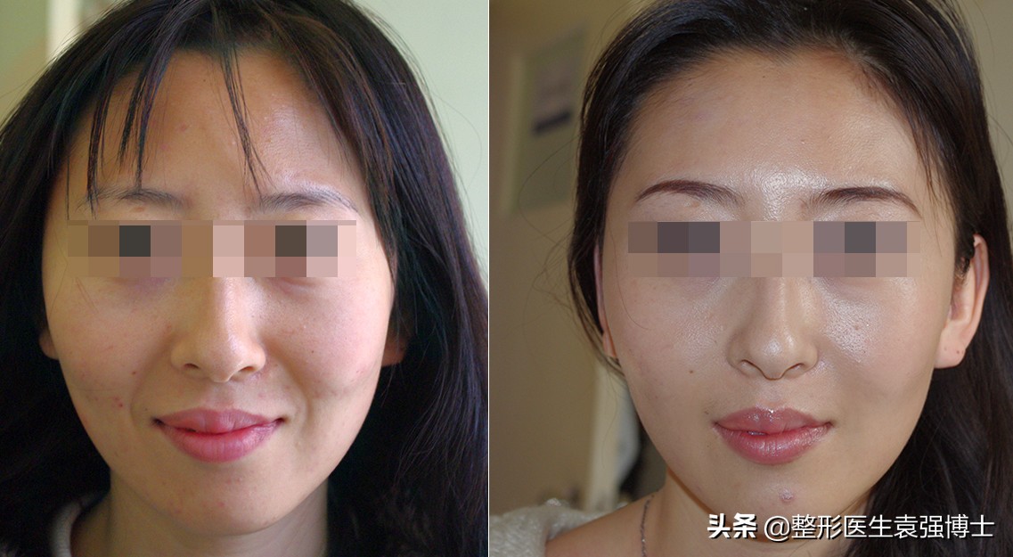 法令纹拉皮手术的全过程,40岁皮肤松弛法令纹明显做拉皮