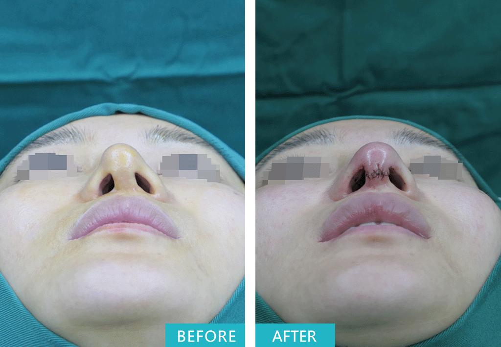 十年隆鼻什么情况下需要重做,10年歪鼻子能修复吗