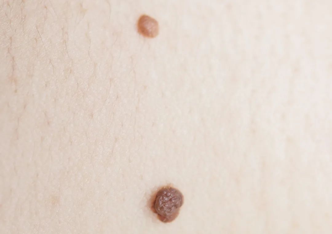 痣长得多好吗,痣比较多正常吗