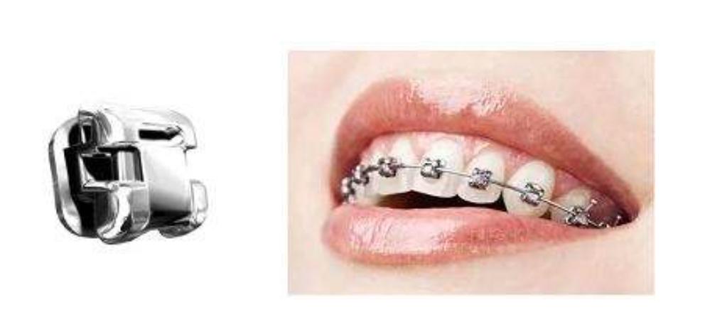 传统牙套和隐形牙套区别,牙套自锁和非自锁区别