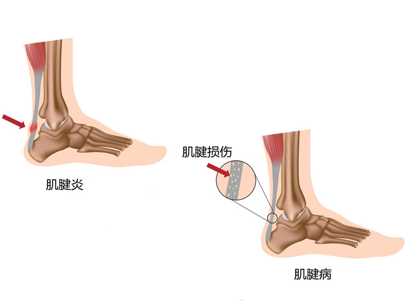 胳膊肘疼是颈椎引起的吗,胳膊疼是肌腱炎吗怎么治