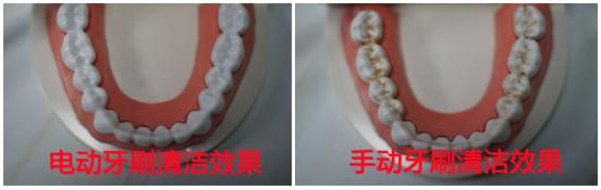 电动牙刷能去掉牙齿上的黑渍吗,小孩用电动牙刷会导致牙齿脱矿吗