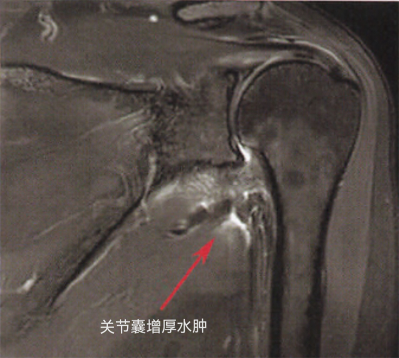 秦皇岛军工医院运动医学门诊医生带您了解“肩周炎”