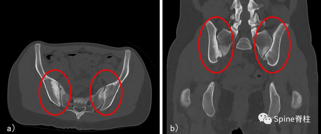 女性慢性腰痛谨防致密性髂骨炎,产后腰痛要做什么检查