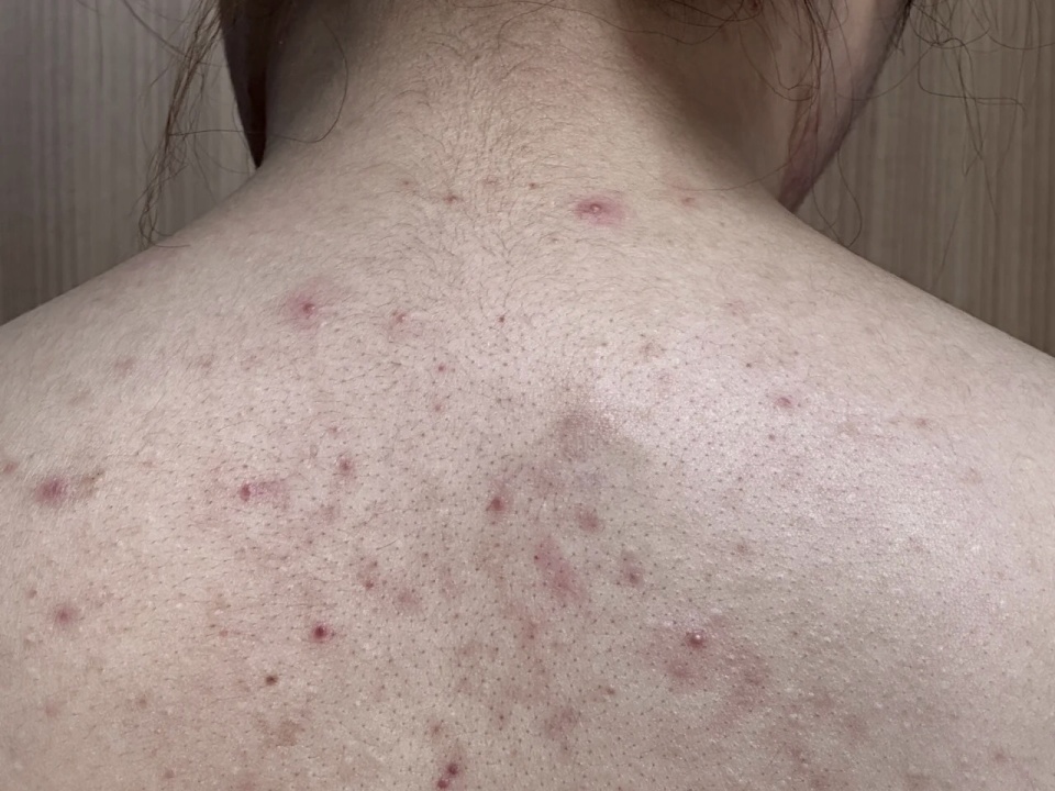 满背痘痘的治疗方法,脓包痘祛痘最有效的方法