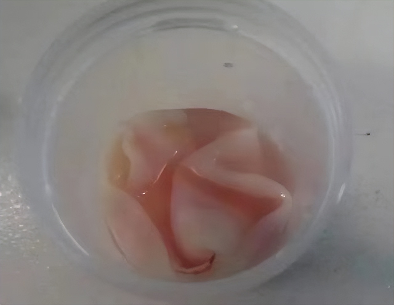 痔疮反复发作肛周肿块,痔疮复发肛门像有个仙人球