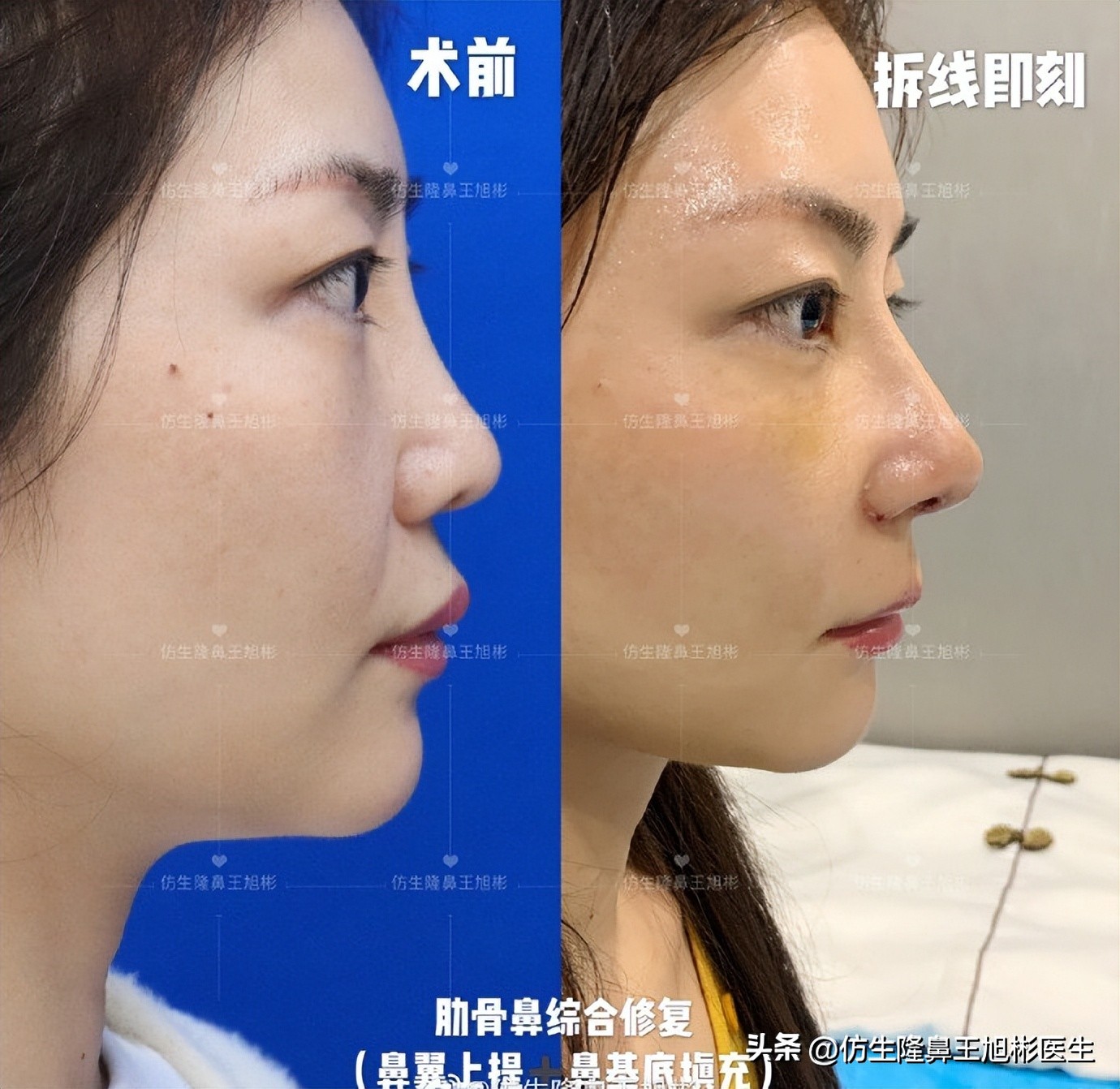 耳软骨隆鼻鼻小柱也是用耳软骨吗,耳软骨隆鼻可以摸到鼻尖的软骨吗