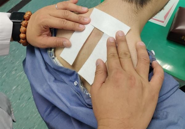 小儿支气管哮喘治疗过程中，配合穴位敷贴护理，收效更佳