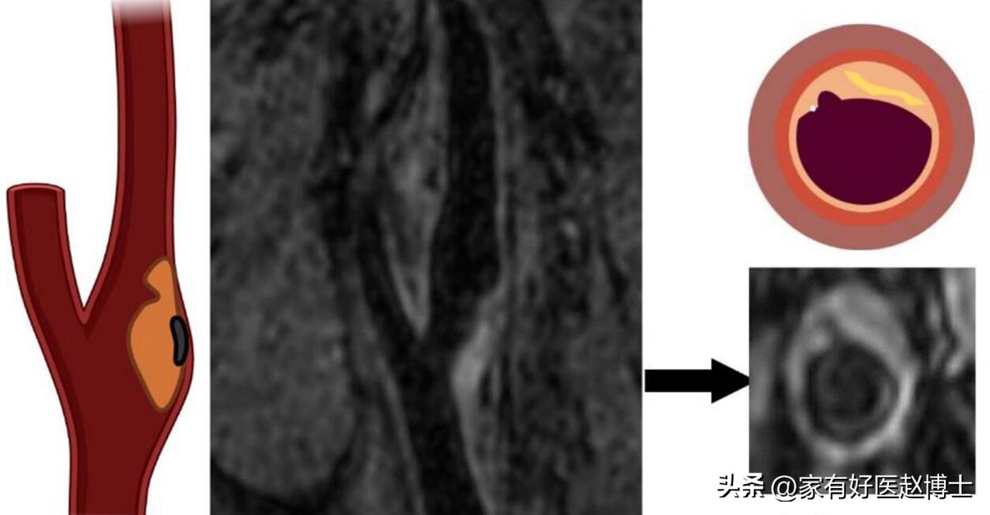 超声检查到的斑块多大才危险,超声检查颈动脉完全闭塞准吗