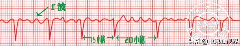 护考几种常见的心电图,常见的心电图图形分析