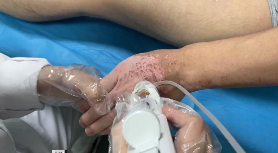 靶向治疗白癜风的效果怎么样,蓝氧靶向