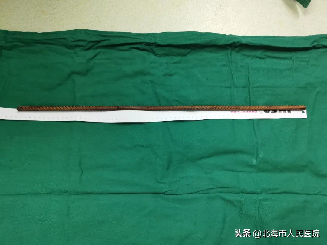 男子被十几根钢筋刺穿,北海一工人被钢筋刺穿