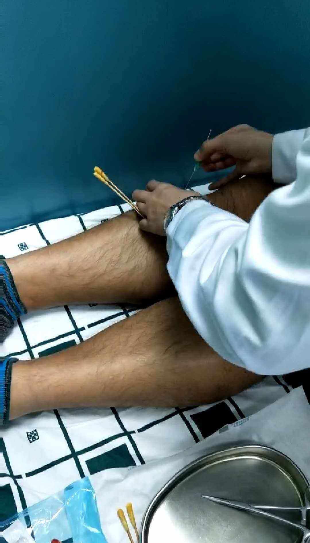 中医脚底筋膜炎如何彻底治愈,筋膜炎肩部最快的治疗方法中医