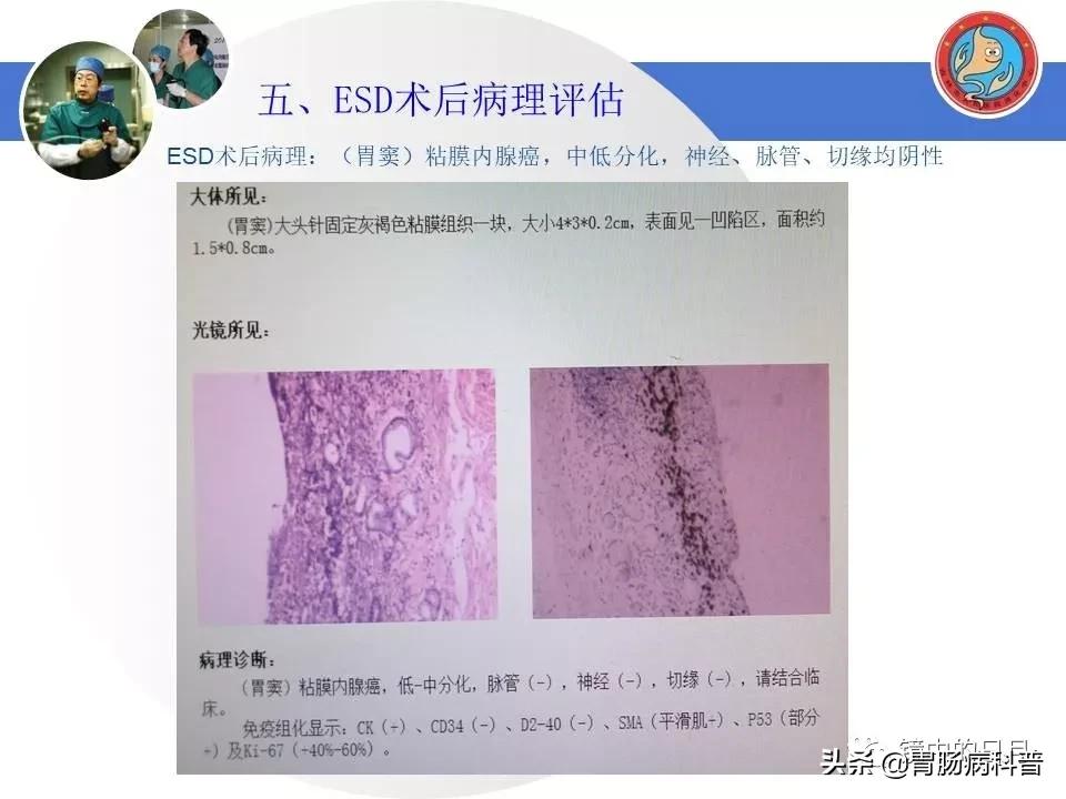 胃癌可以做内镜手术吗,早期胃癌内镜手术后追加外科手术