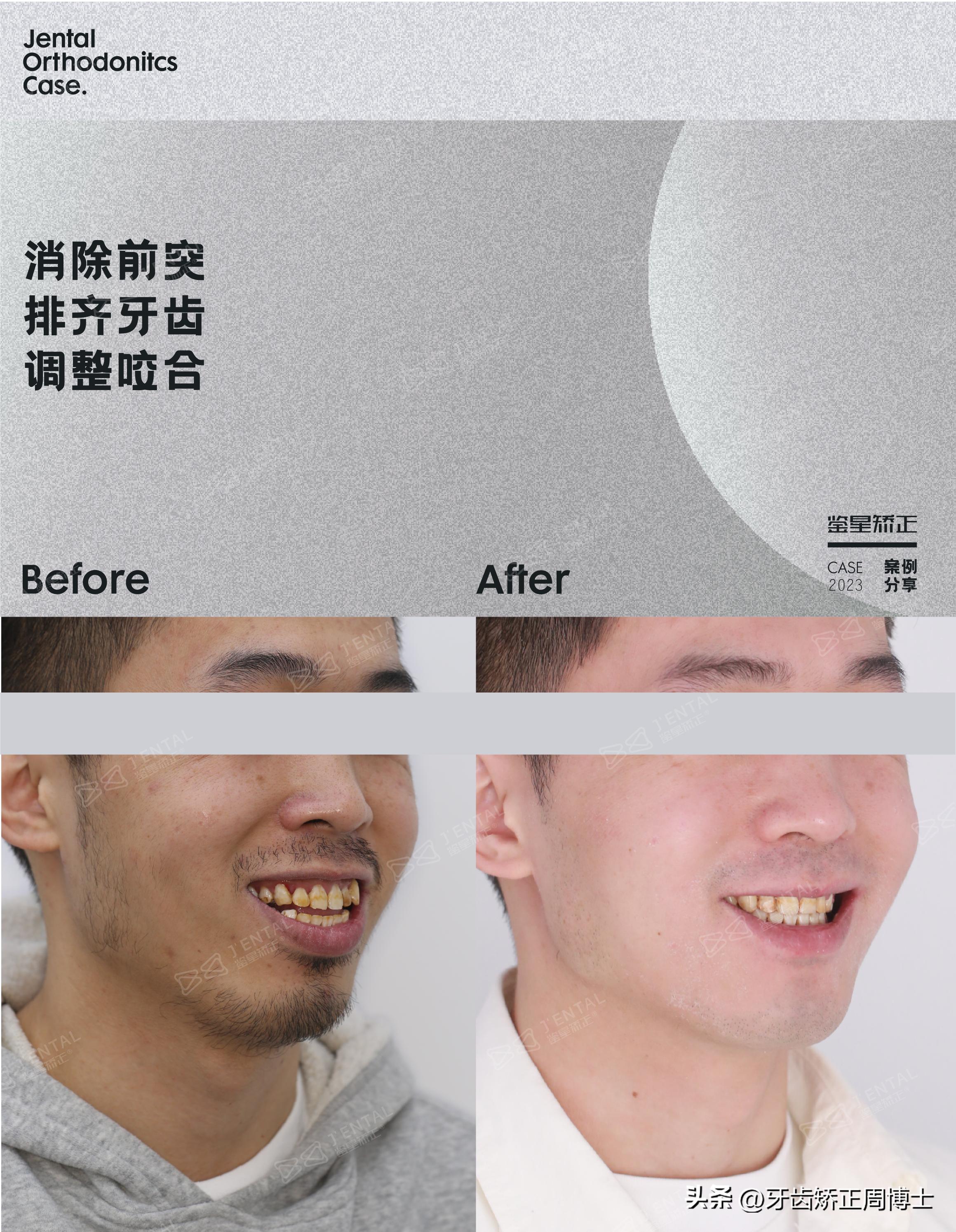 智齿正畸替代第二磨牙危害,智齿矫正代替第二磨牙3d图