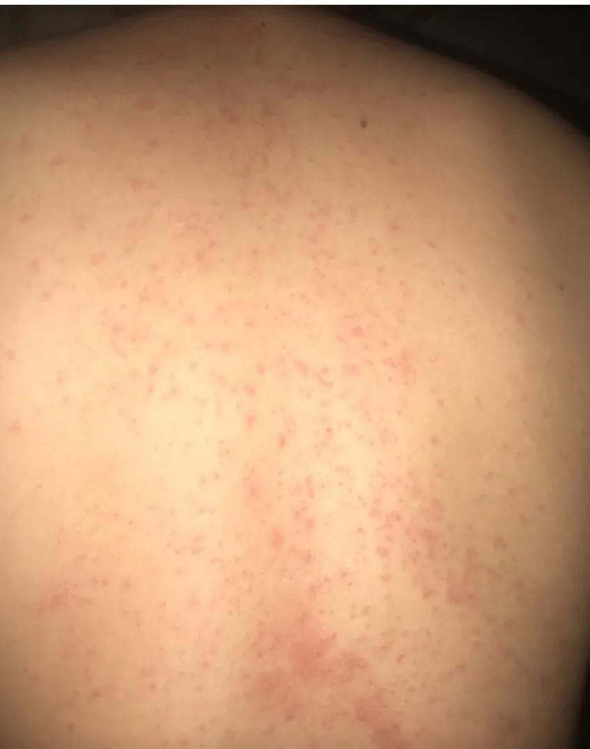 阳康后背上长痘,阳康后后背长疹子