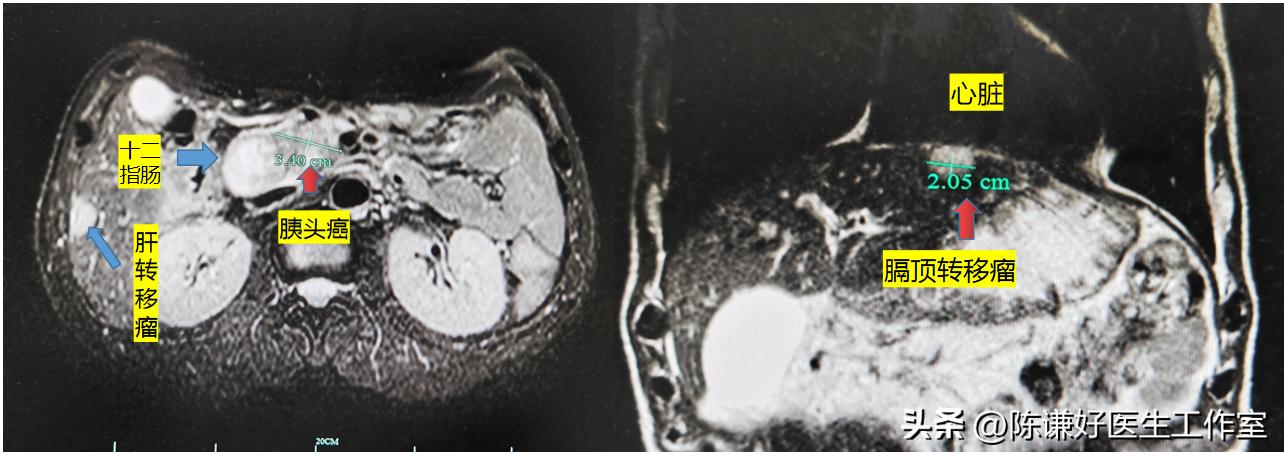 晚期胰腺癌肝转移海扶刀治疗病例（胰腺癌系列19015例）