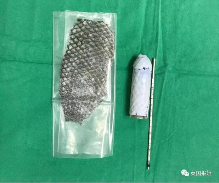 一男子为了变性为女生,竟然用鱼皮造了*体下**