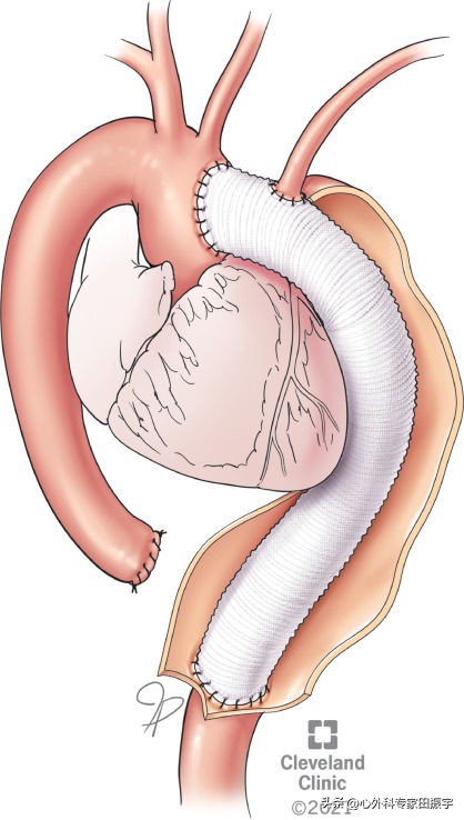 Kommerell憩室和迷走型锁骨下动脉修复术