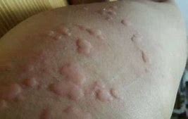 湿疹荨麻疹全身皮肤痒是什么原因,皮肤瘙痒荨麻疹的原因及治疗方法