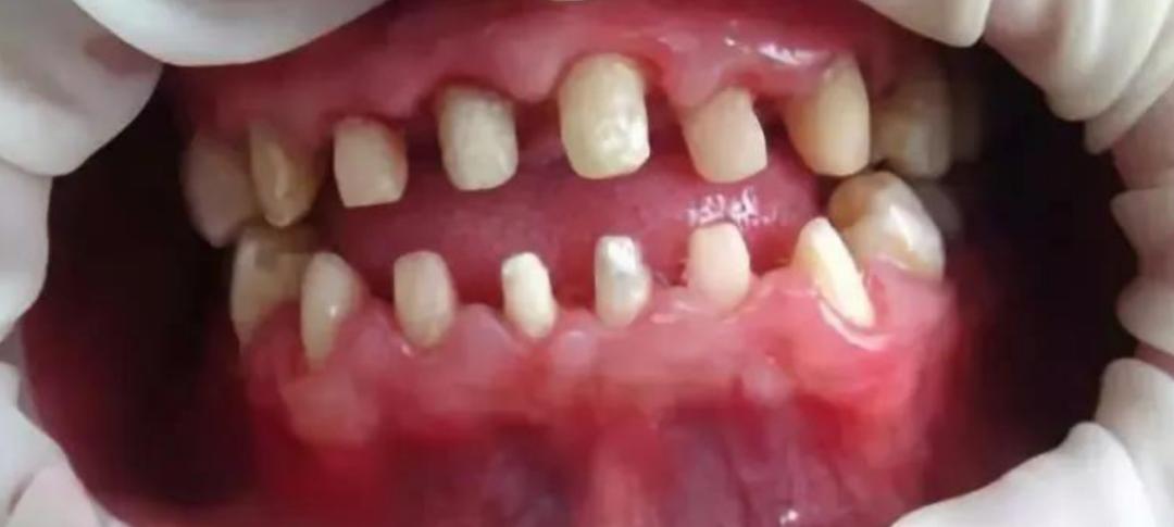 缺牙后哪种补牙性价比高,缺牙想补牙去哪里比较划算