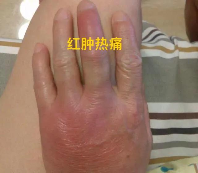 颈肩腰腿疼怎么选择膏药贴,颈肩腰腿疼痛选穴方法