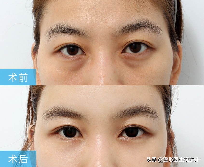 之前做了祛眼袋泪沟特别明显,北京去眼袋手术前后对比