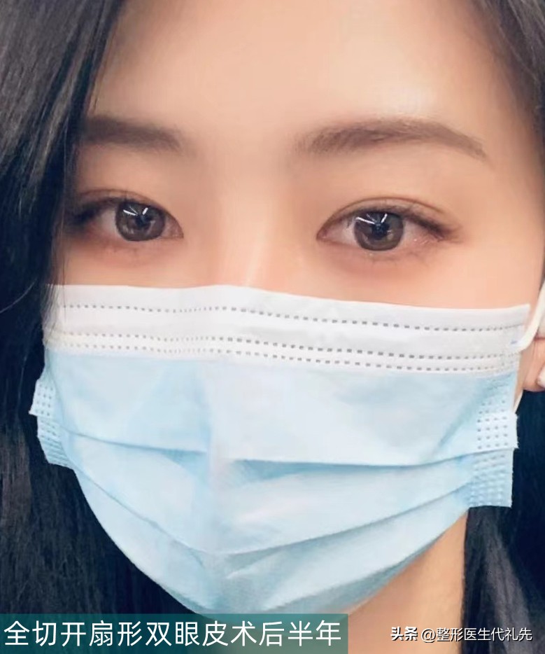 40岁眼皮下垂松弛全切双眼皮,40岁全切双眼皮后1-7天恢复图