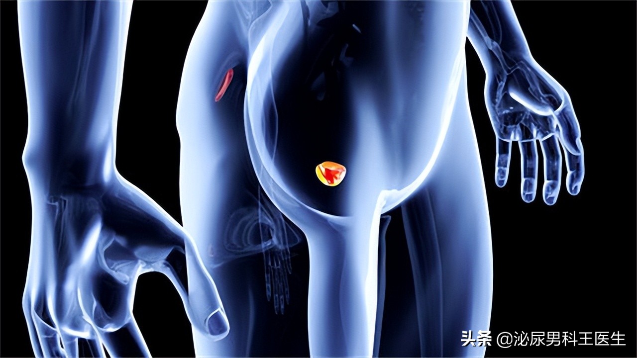 前列腺癌晚期骨转移症状有哪些,前列腺癌晚期患者临终前15个症状