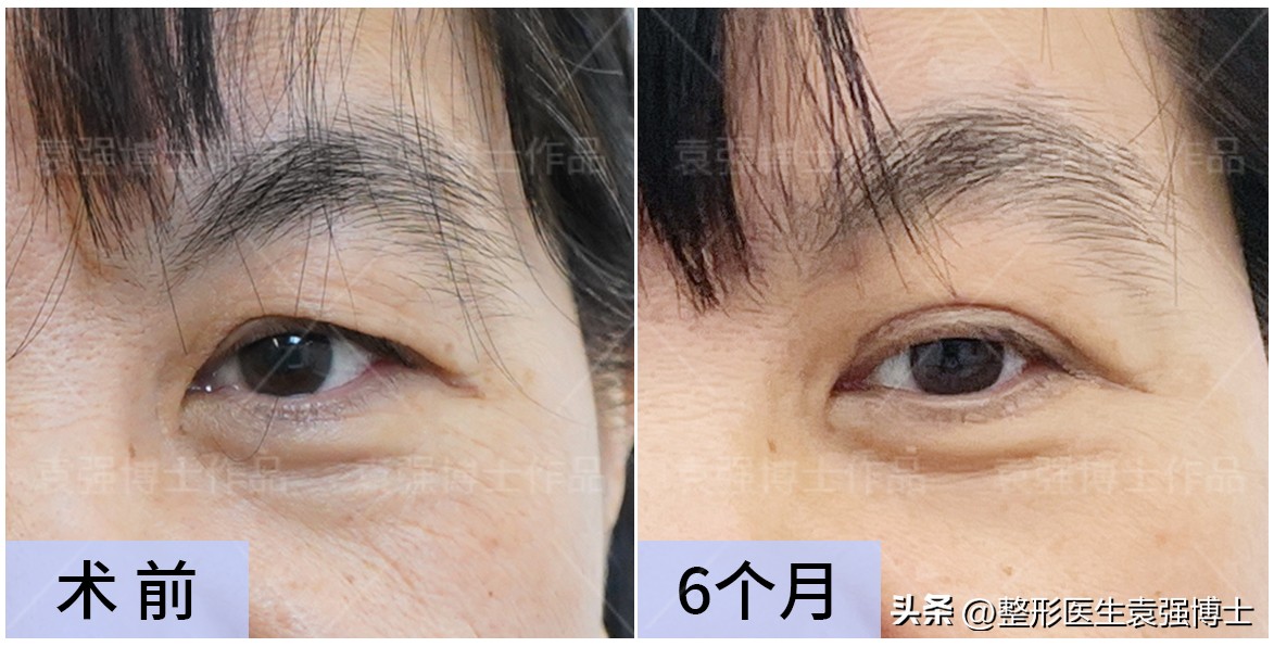 如何解决眼周衰老症状,眼周肌肤出现衰老怎么办