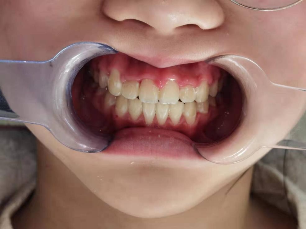 徐州儿童牙齿矫正牙齿不齐,大连口腔医院儿童牙齿矫正怎么样