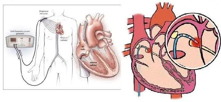 心脏射频消融机器,射频消融导管磁定位型