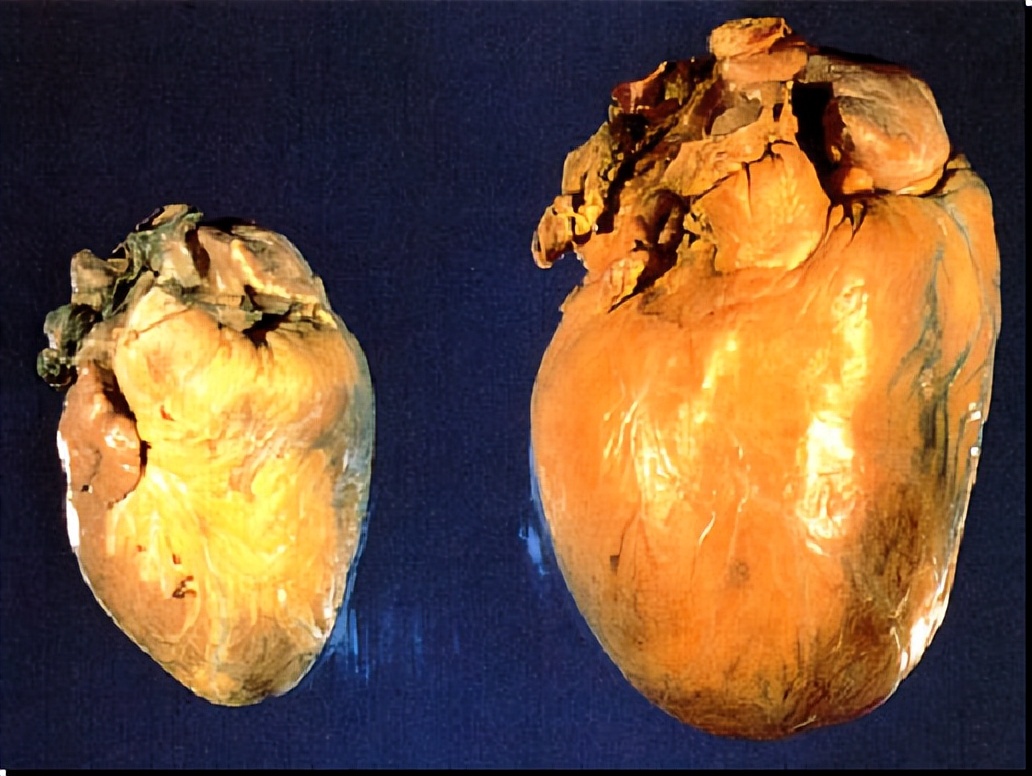 扩张型心肌病视频讲解,扩张型心肌病讲解护考