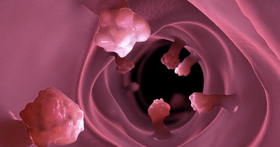 为什么会肠道长息肉,肠道容易长息肉是什么原因