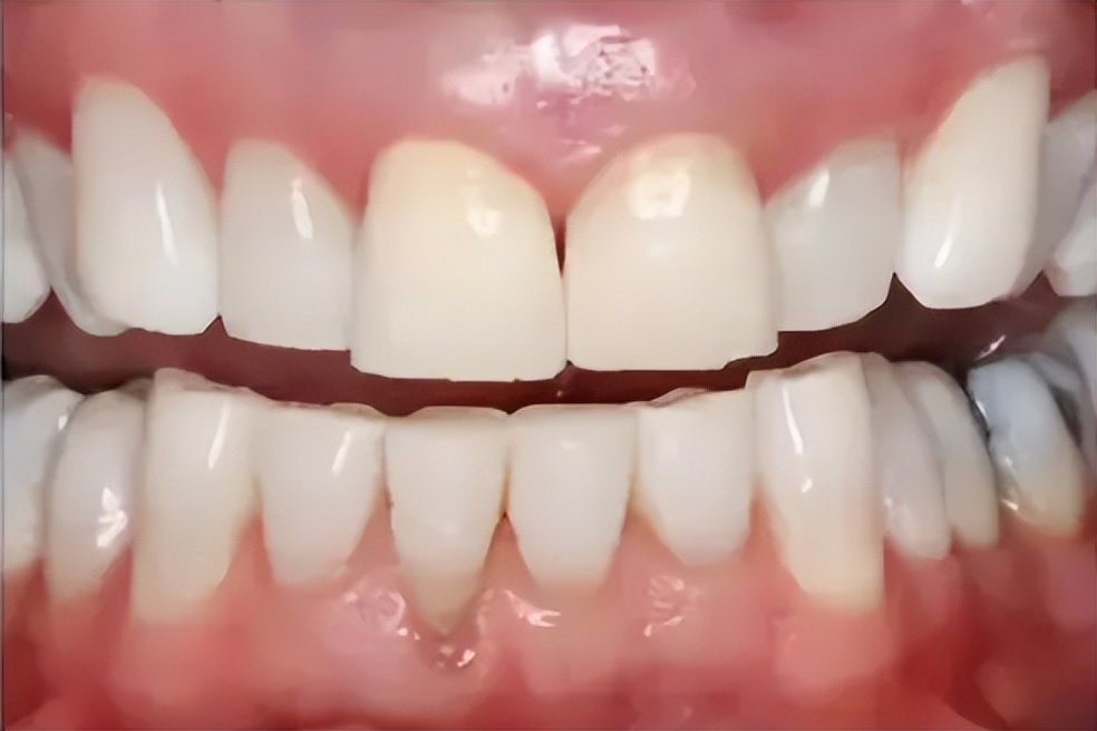 牙垢牙渍口臭,去除口臭牙渍的有效方法