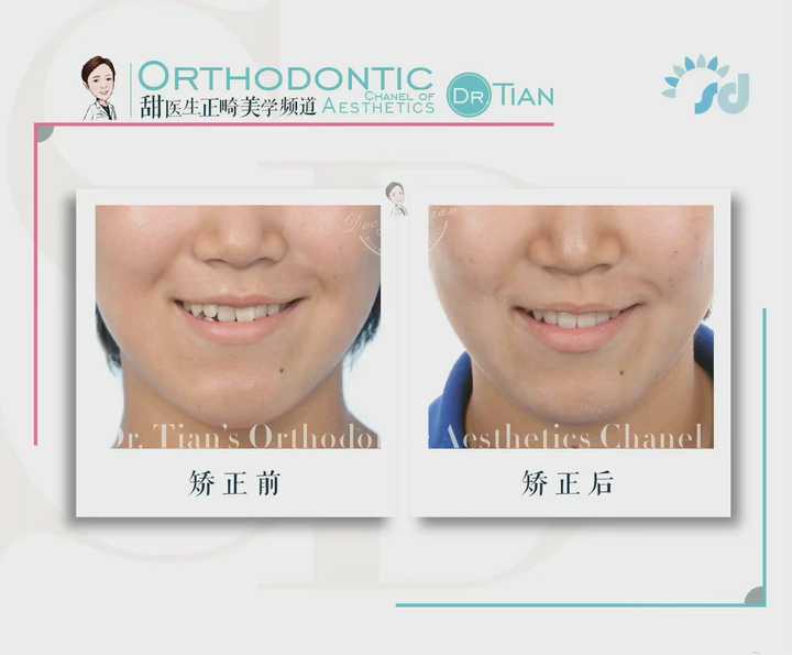 偏侧咀嚼脸型不对称的补救方法,大小脸不对称矫正