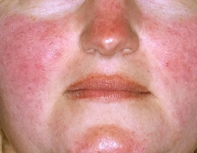 鼻子毛孔粗大黑头泛红怎么解决,鼻翼两侧有黑头还泛红如何护肤