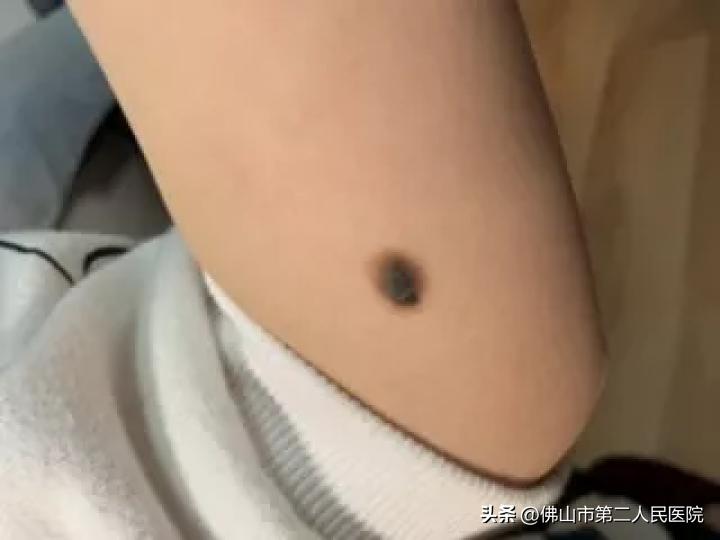 年轻歌手得黑色素瘤去世,歌手黑痣和黑色素瘤的区别