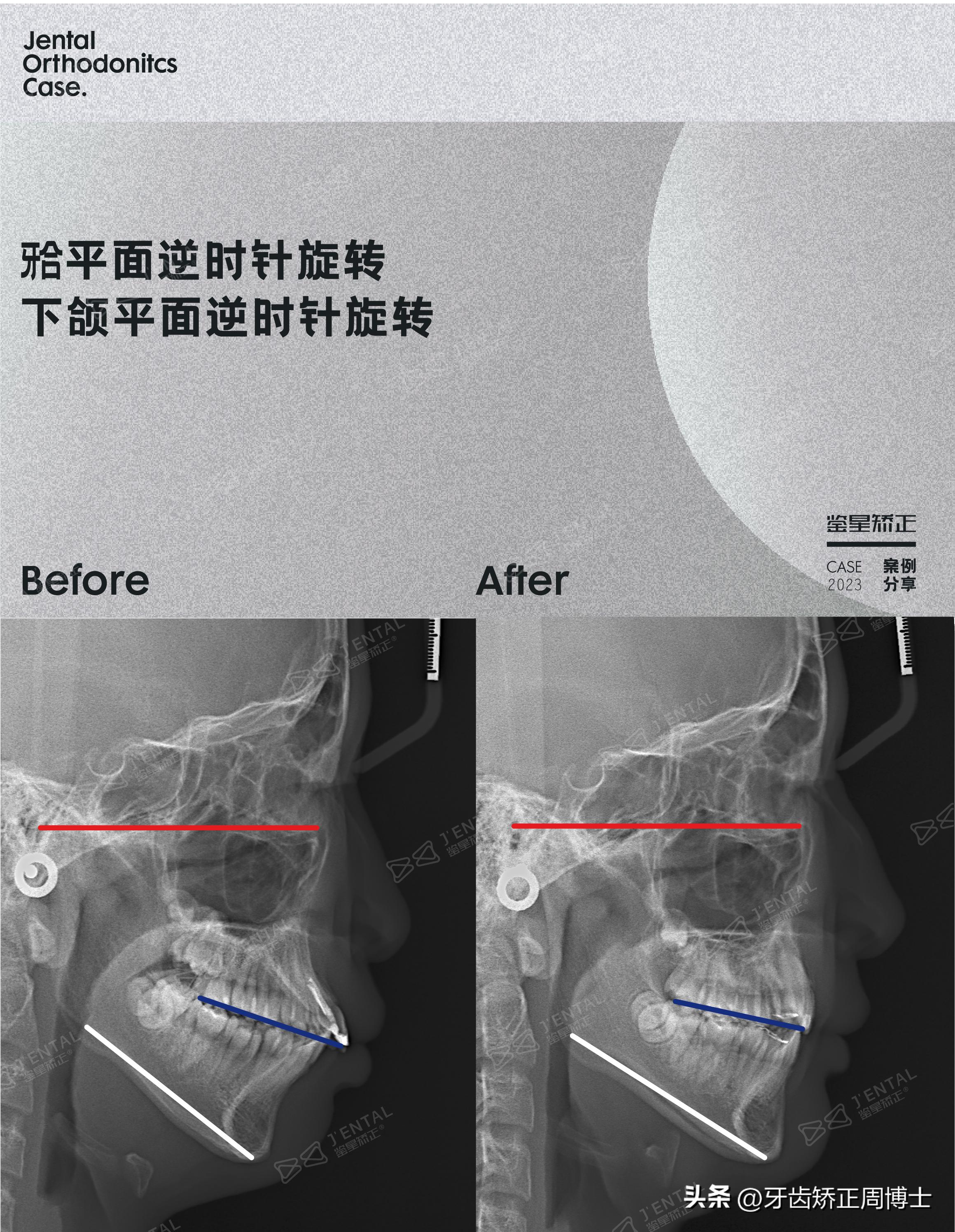 拔掉大牙做矫正好还是植牙好,拔掉4颗牙齿正畸收缝有几种方法