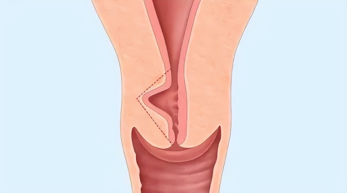 子宫憩室经期延长危害,子宫切口憩室做手术可以痊愈吗