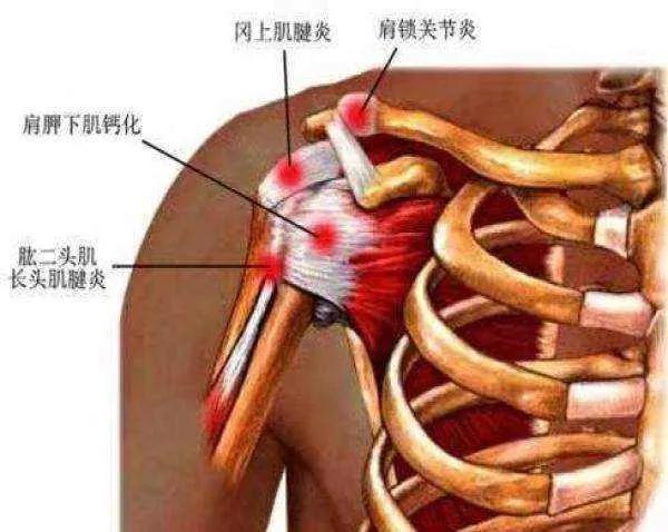 健身屈肘外旋肩部疼痛,外旋屈肘
