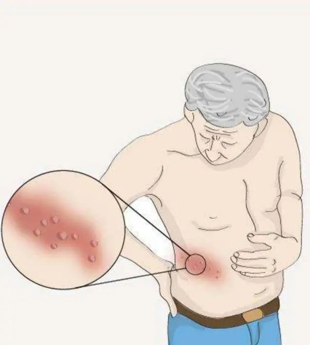 老年人带状疱疹的症状和治疗方法,带状疱疹发病前1-3天首先出现症状